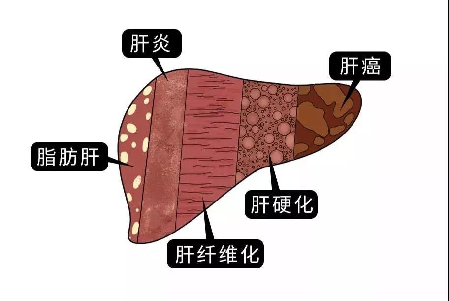 脂肪肝的最大敵人不是肥胖，答案竟是這樣！