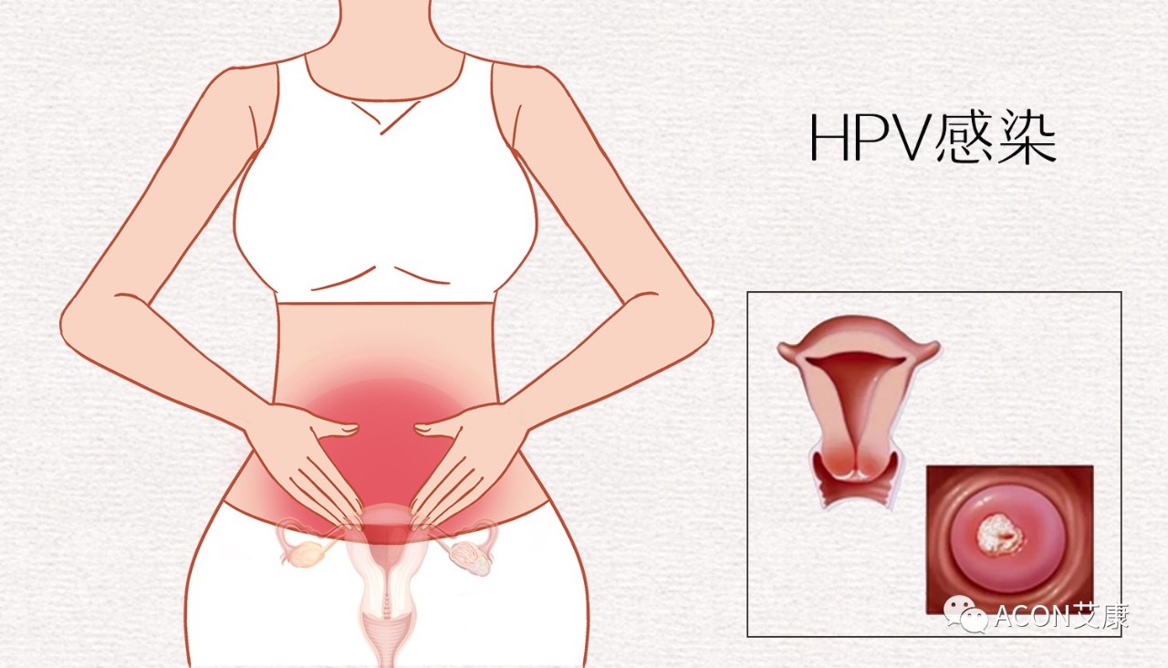 HPV轉(zhuǎn)陰其實(shí)很簡(jiǎn)單， 女性必知的宮頸癌真相