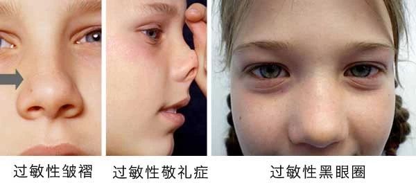 過敏性鼻炎會讓孩子變傻？！家長該如何應(yīng)對